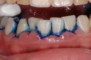 牙周治療方法