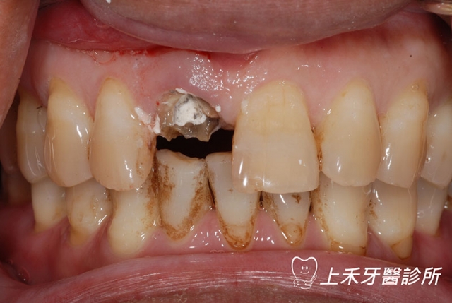 拔牙 立即植牙+補骨 - 01(門牙假牙鬆脫)