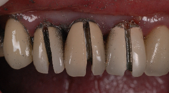 前牙美學 -- 舊假牙蛀牙  拆除治療